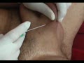 penis syringe